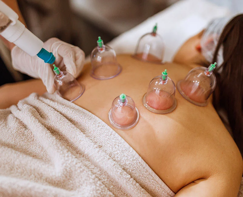 natte cupping behandeling