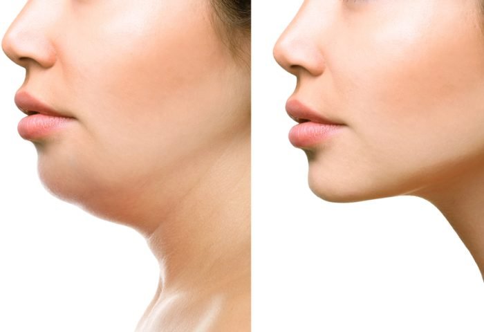 vetoplossende mesotherapie