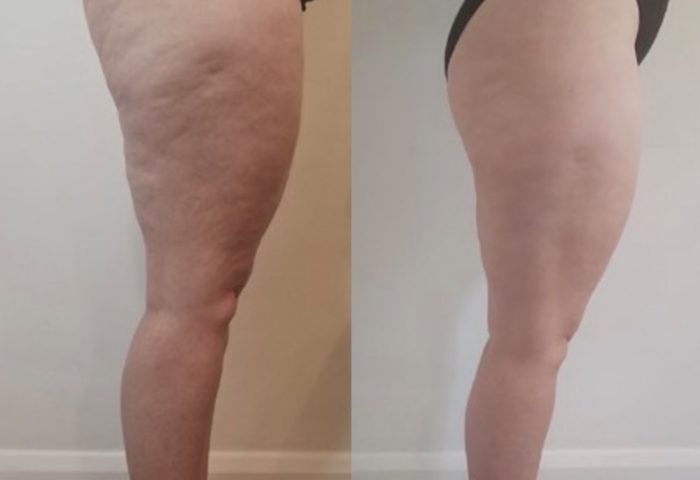 Anti-Cellulite mesotherapie