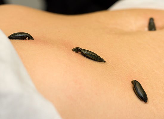 Bloedzuigertherapie in Amsterdam