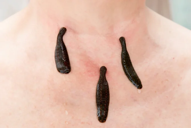 Bloedzuiger Behandeling