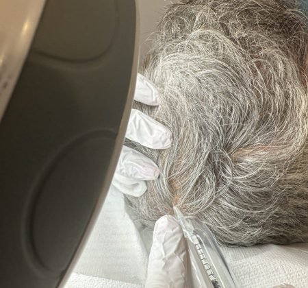 haarfiller behandeling