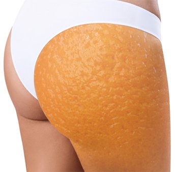 Anti-cellulite Mesotherapie