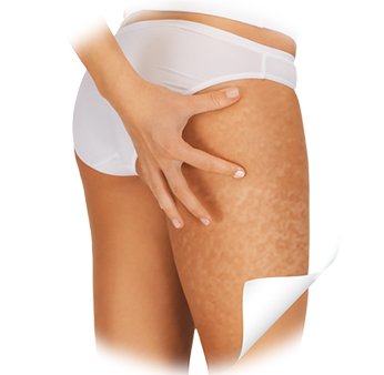 Anti-cellulite Mesotherapie