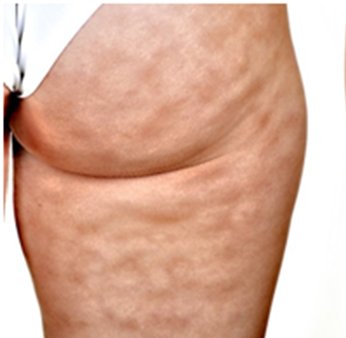 Anti-cellulite Mesotherapie