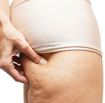 Anti-cellulite Mesotherapie