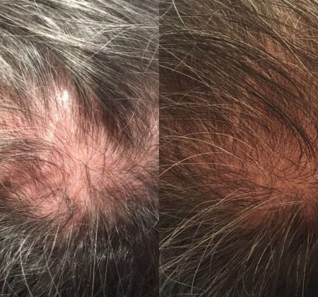 HYALURONZUUR EN HUIDVEROUDERING