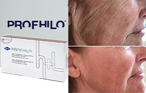 Profhilo - Hyaluronzuur Filler
