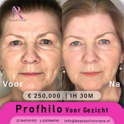 Hyaluronzuur Profhilo for face