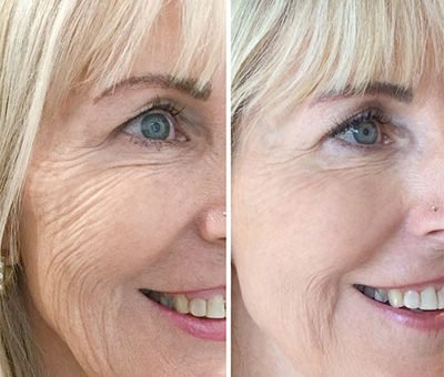 skinbooster behandeling Amsterdam