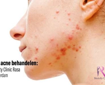 puistjes (acne)