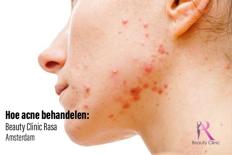 puistjes (acne)