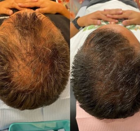 Haarbooster behandeling Amsterdam