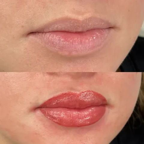 Lip pigmentatie amsterdam