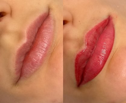 Lip pigmentatie amsterdam