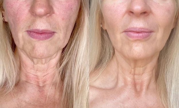 microneedling before after