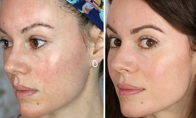HIFO & microneedling before after