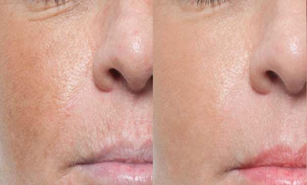 HIFO & microneedling before after