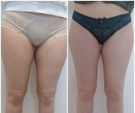 HIFU Binnen Dijen Amsterdam