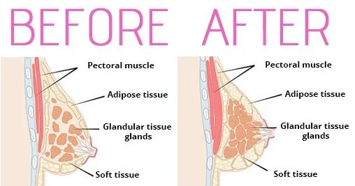 HIFU Borsten Amsterdam