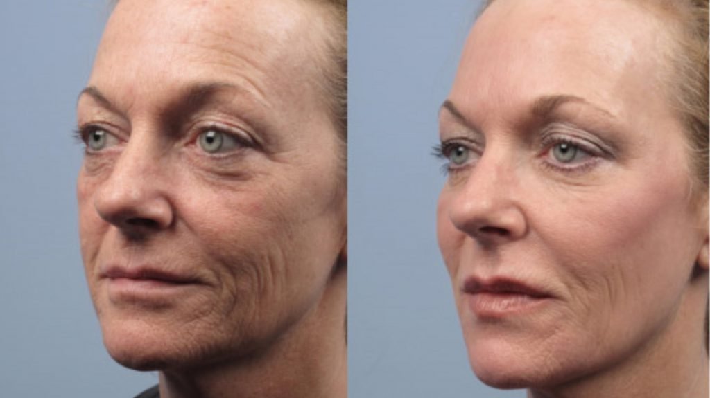 HIFU Boven de Ogen Amsterdam