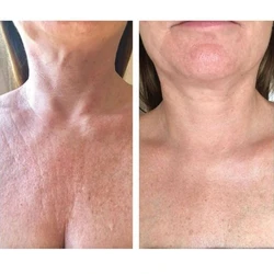 HIFU Decollete Amsterdam