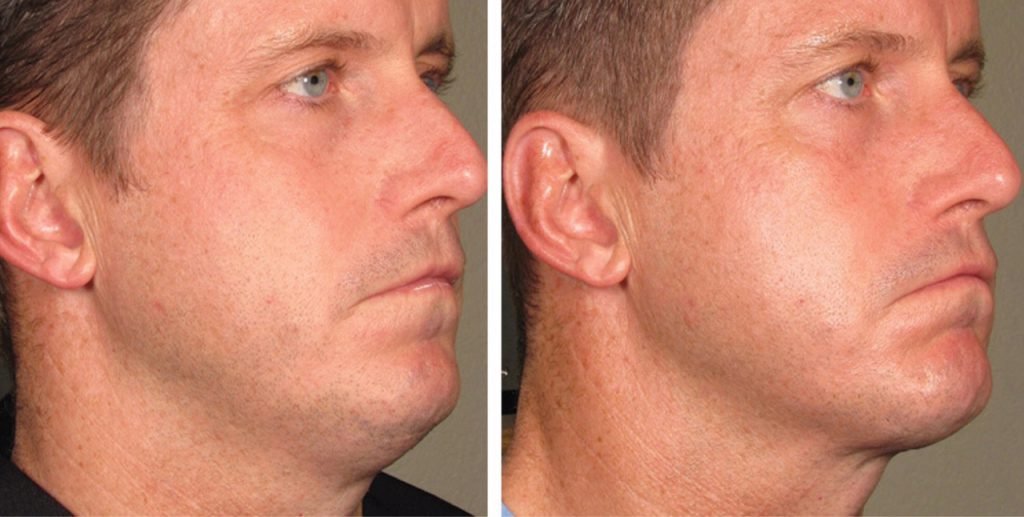 HIFU kaaklijn en onderkin Amsterdam