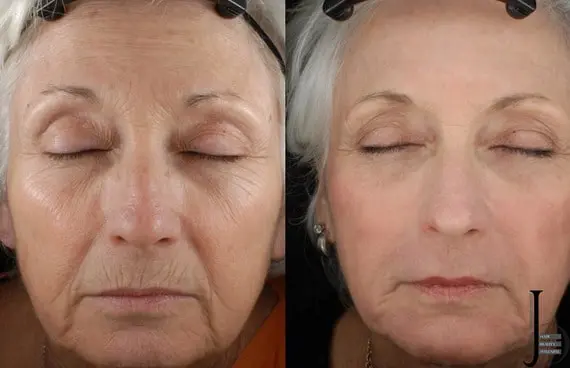 HIFU voorhoofd Amsterdam