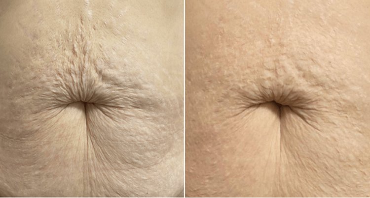 Lichaam Microneedling Anti-aging Amsterdam