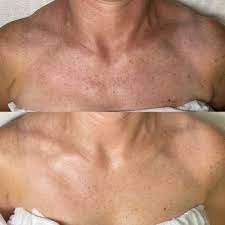 Lichaam Microneedling Peeling Amsterdam