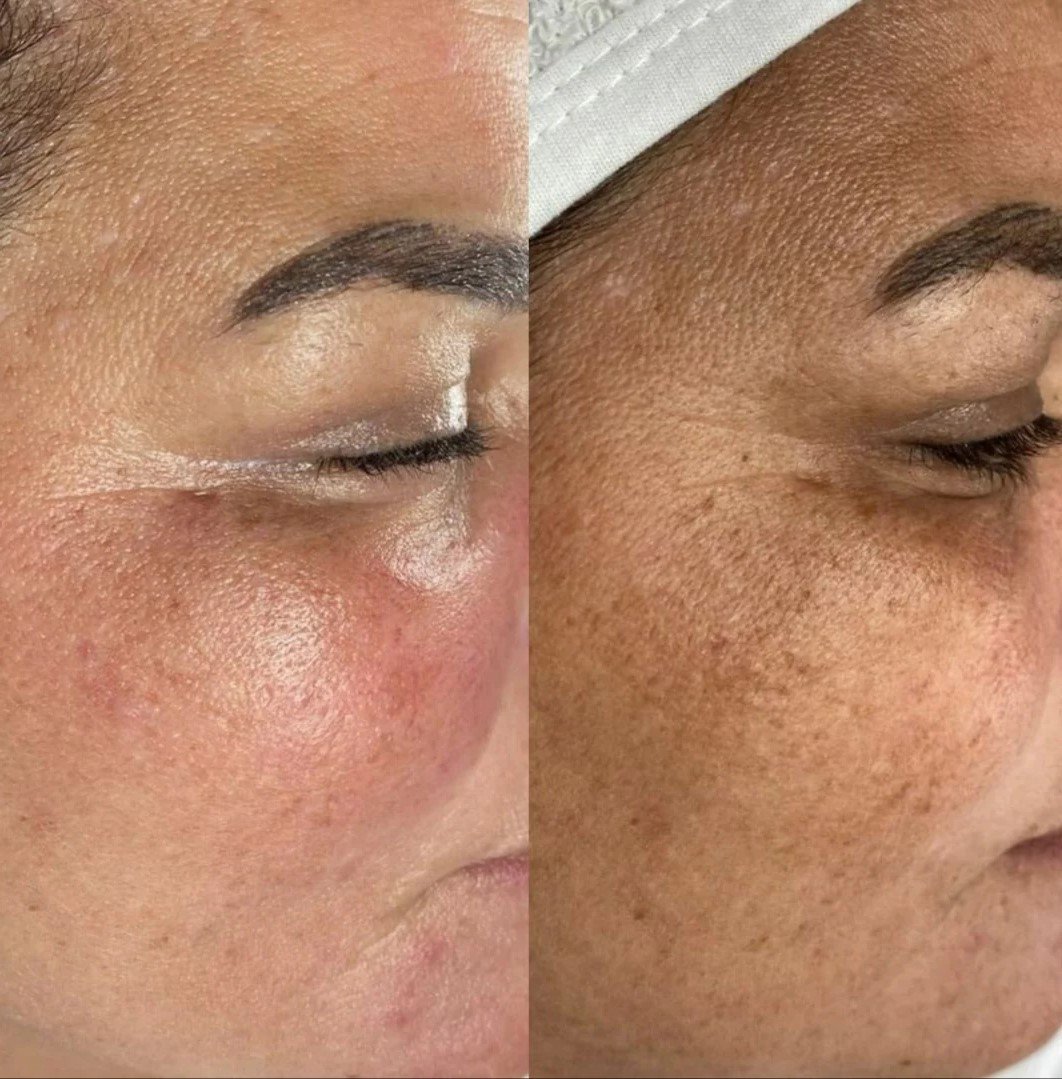 Mesotherapie & Microneedling Peeling Amsterdam