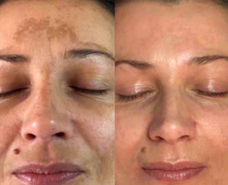 Mesotherapie Vlekken Verwijderen Amsterdam