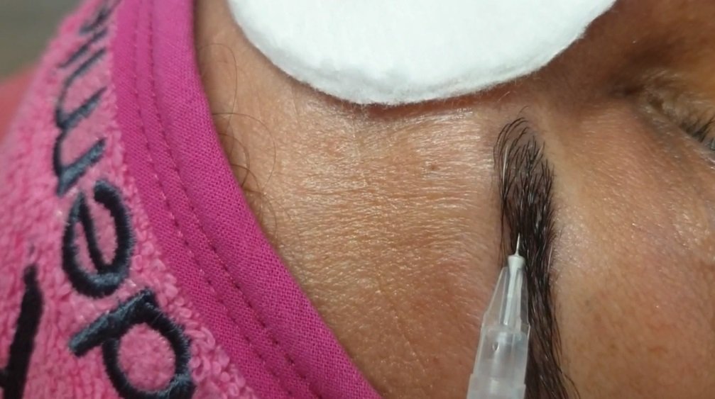 Mesotherapie Wenkbrauw Amsterdam