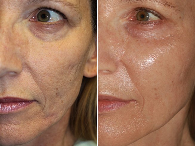 Microneedling Anti-aging Amsterdam