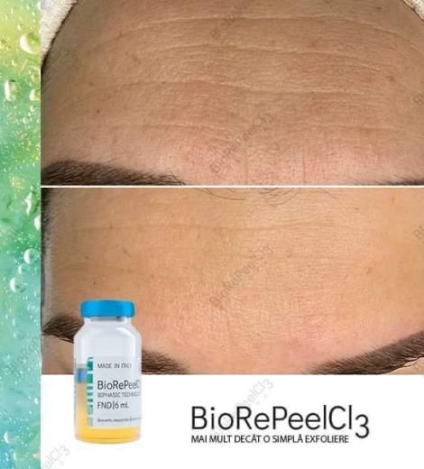 Microneedling + BIORePeelCI3