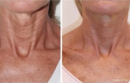 Microneedling + BIORePeelCI3 Amsterdam