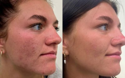 Microneedling Peeling Amsterdam