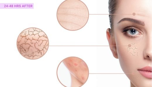 Microneedling Peeling € 125 Amsterdam