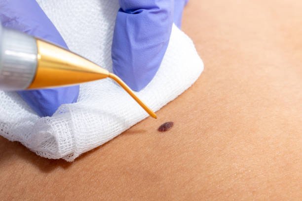 Plasma Fibromen Amsterdam