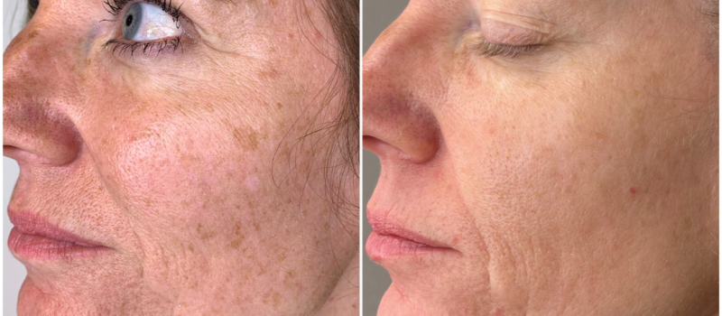 Plasma Vlekken Verwijderen