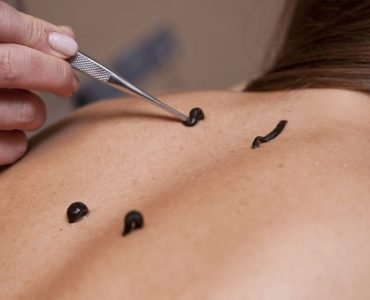 Indicaties voor Bloedzuigertherapie