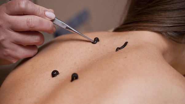 Indicaties voor Bloedzuigertherapie