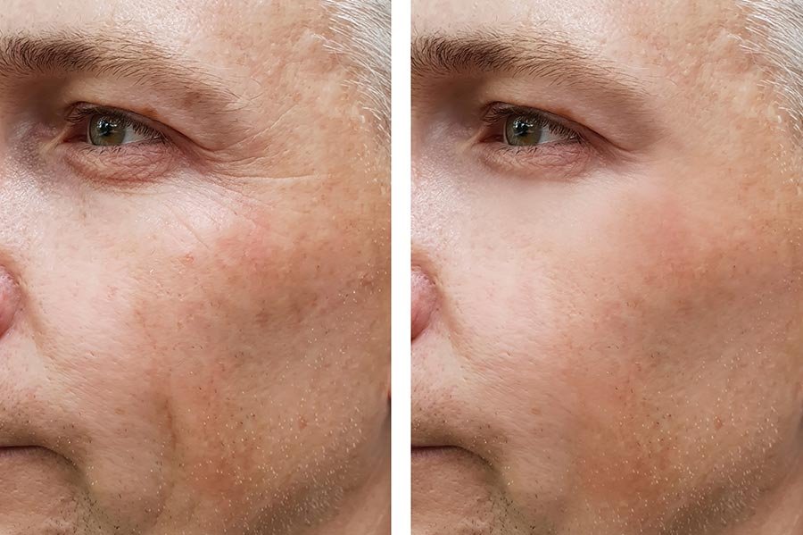 mesoterapie Anti-Aging (alle Gezicht) Amsterdam