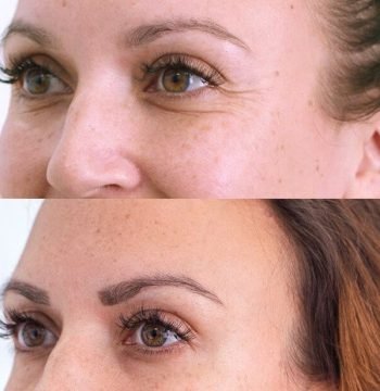 Microbotox Amsterdam