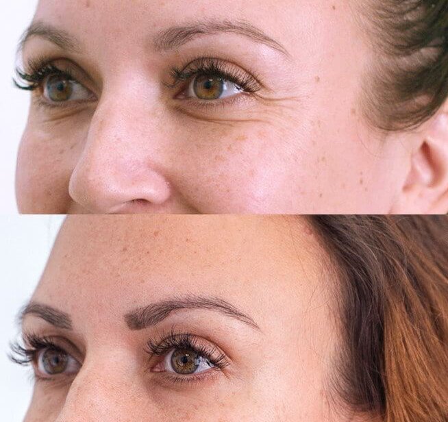 Microbotox Amsterdam