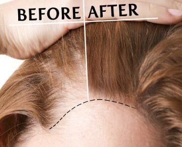 Haar Fillers voor Vrouwen