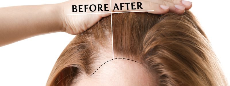 Haar Fillers voor Vrouwen