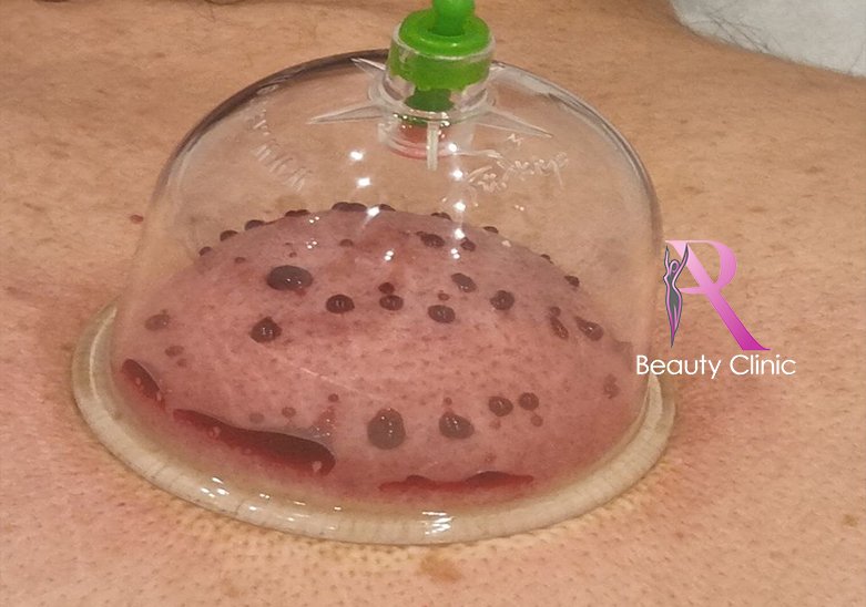 Natte Cupping Amsterdam