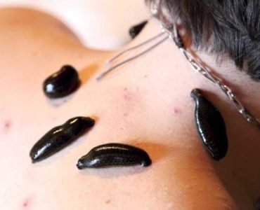 Voordelen van Bloedzuigertherapie