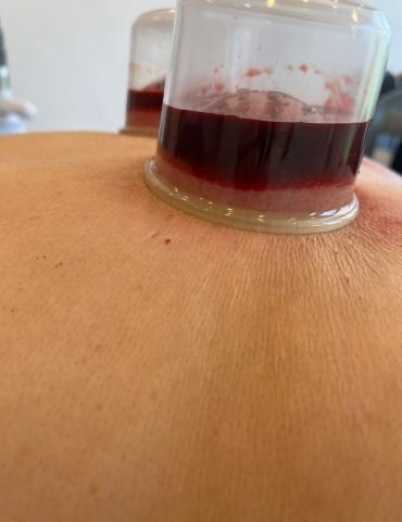Natte Cupping Behandeling Amsterdam